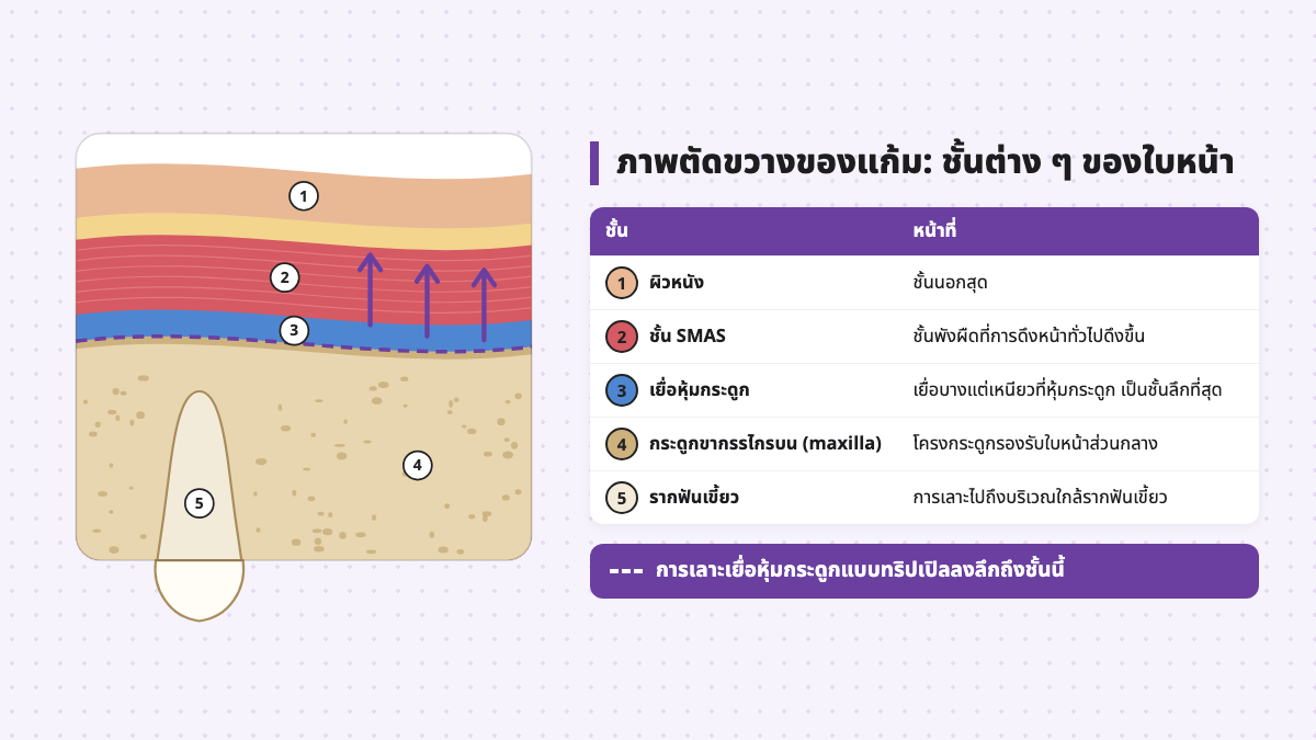 ภาพตัดขวางของแก้มแสดงผิวหนัง ชั้น SMAS เยื่อหุ้มกระดูก กระดูกขากรรไกรบน และรากฟันเขี้ยว